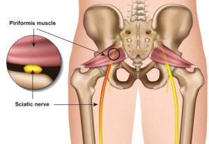 Syndrome du Piriforme